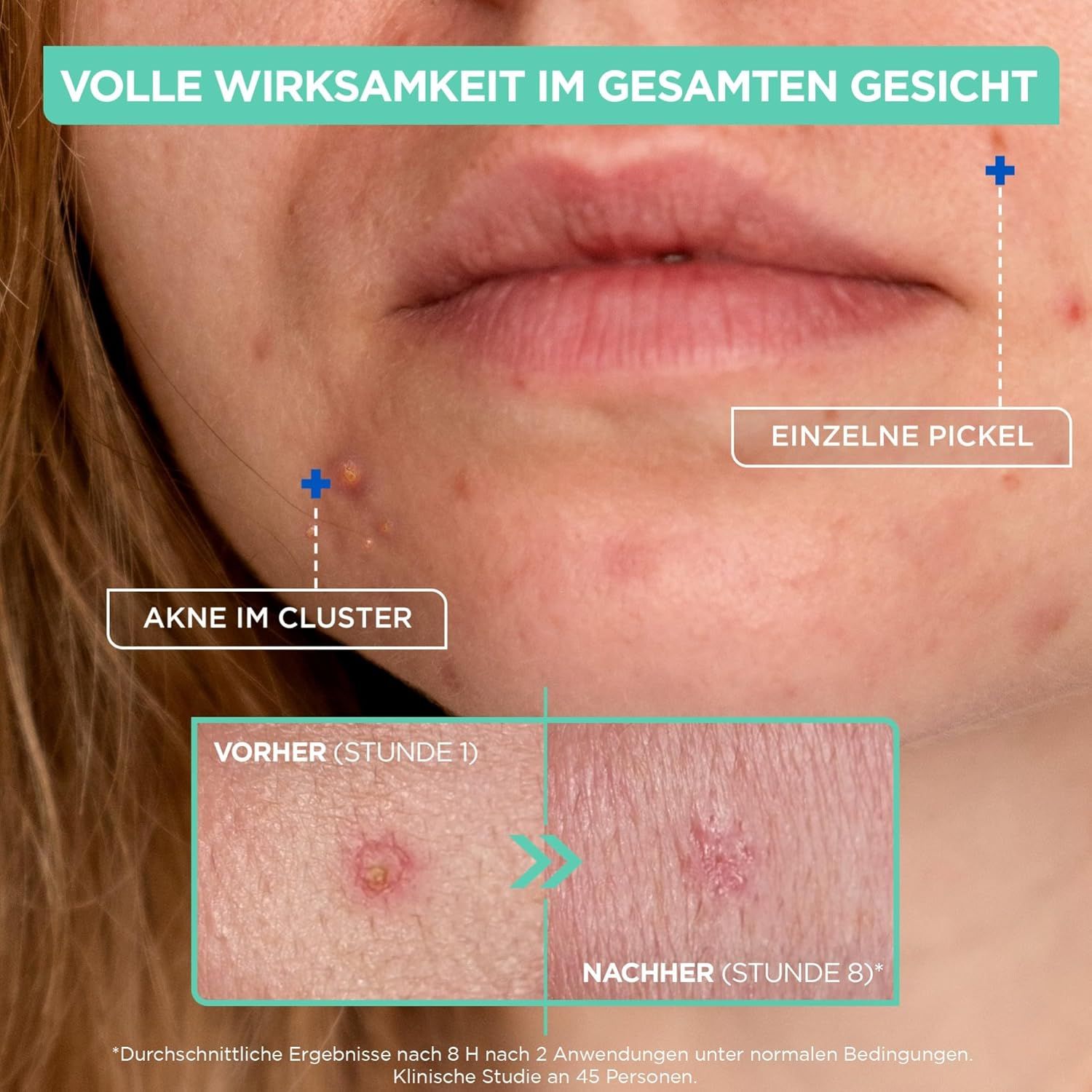 Mixa Konzentrierte Anti Pickel Paste