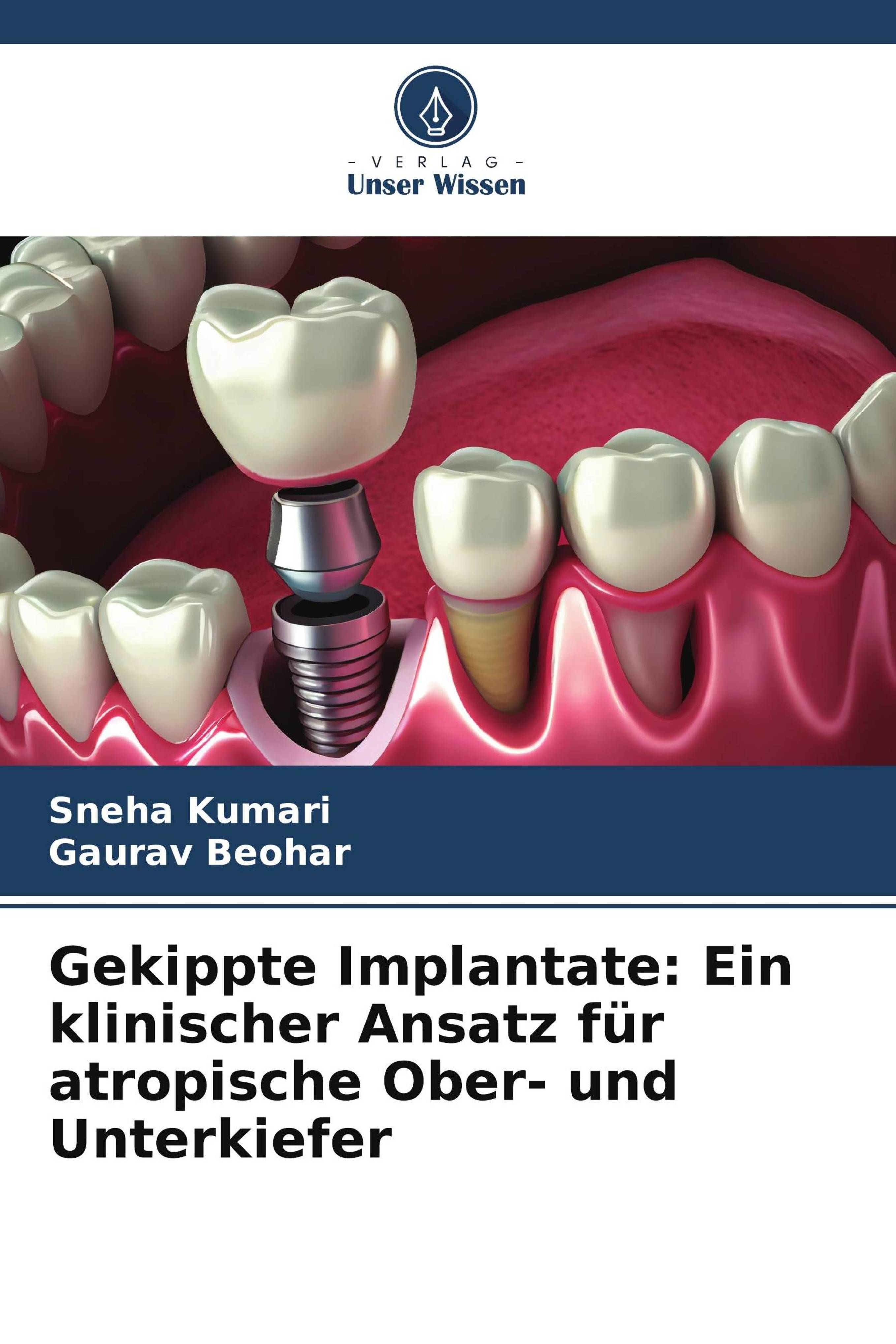 Gekippte Implantate: Ein klinischer Ansatz für atropische Ober- und Unterkiefer DE
