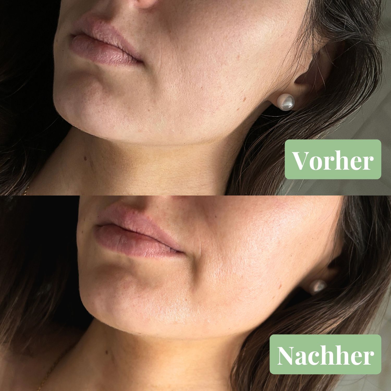 Vorher-Nachher-Vergleich. Zwei Bilder von Unterlippen. Text: Vorher, Nachher. Haut wirkt glatter.