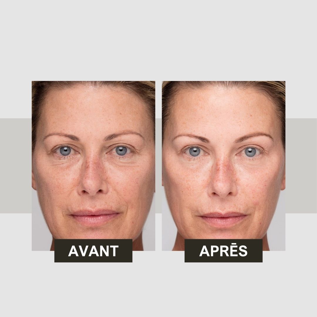 Comparaison avant-après. Deux visages de femme. Gauche : Avant. Droite : Après.