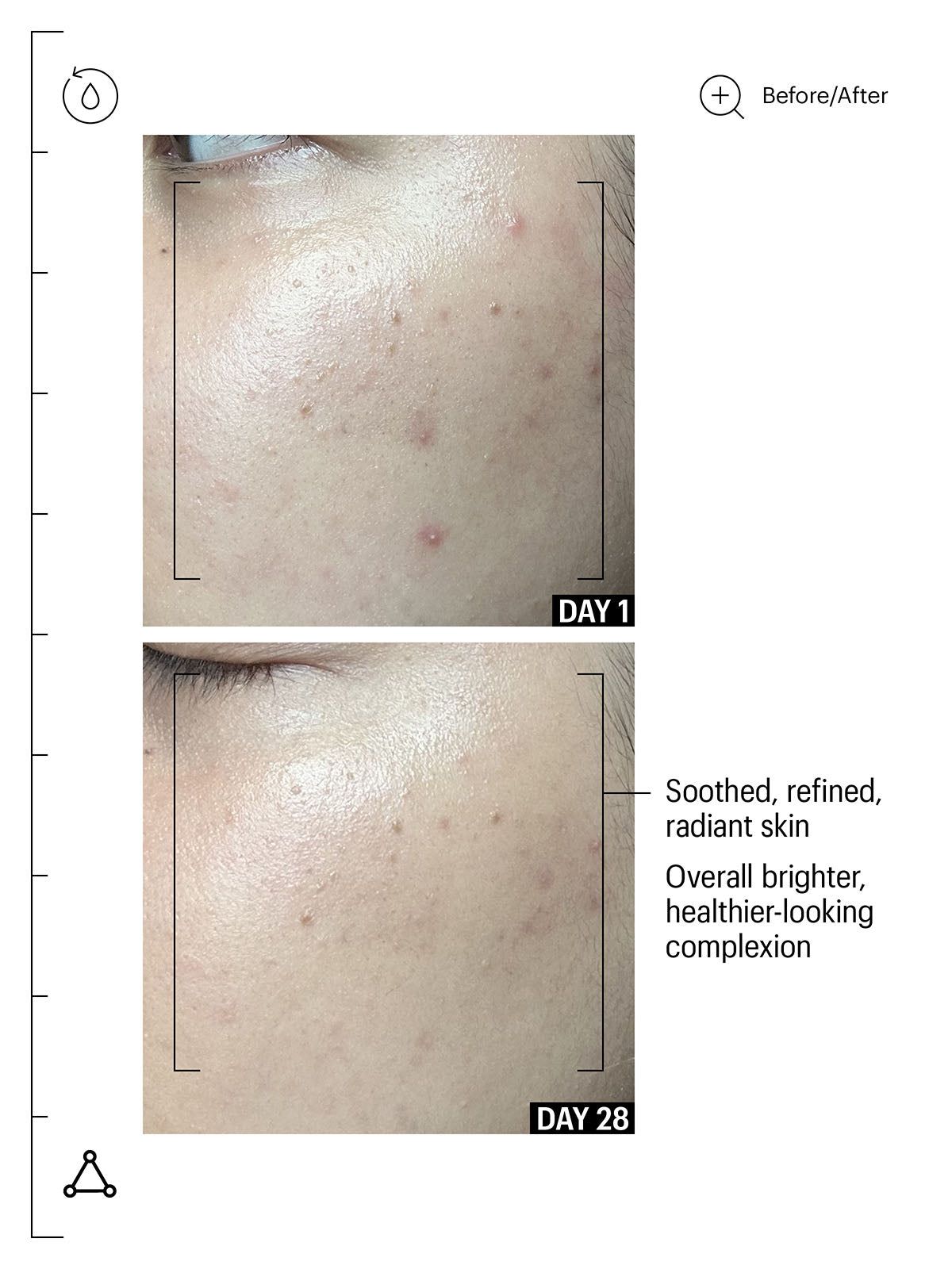 Vorher-Nachher-Vergleich. Haut mit Pickeln (Tag 1) und glattere Haut (Tag 28). Text: Soothed, refined, radiant skin.