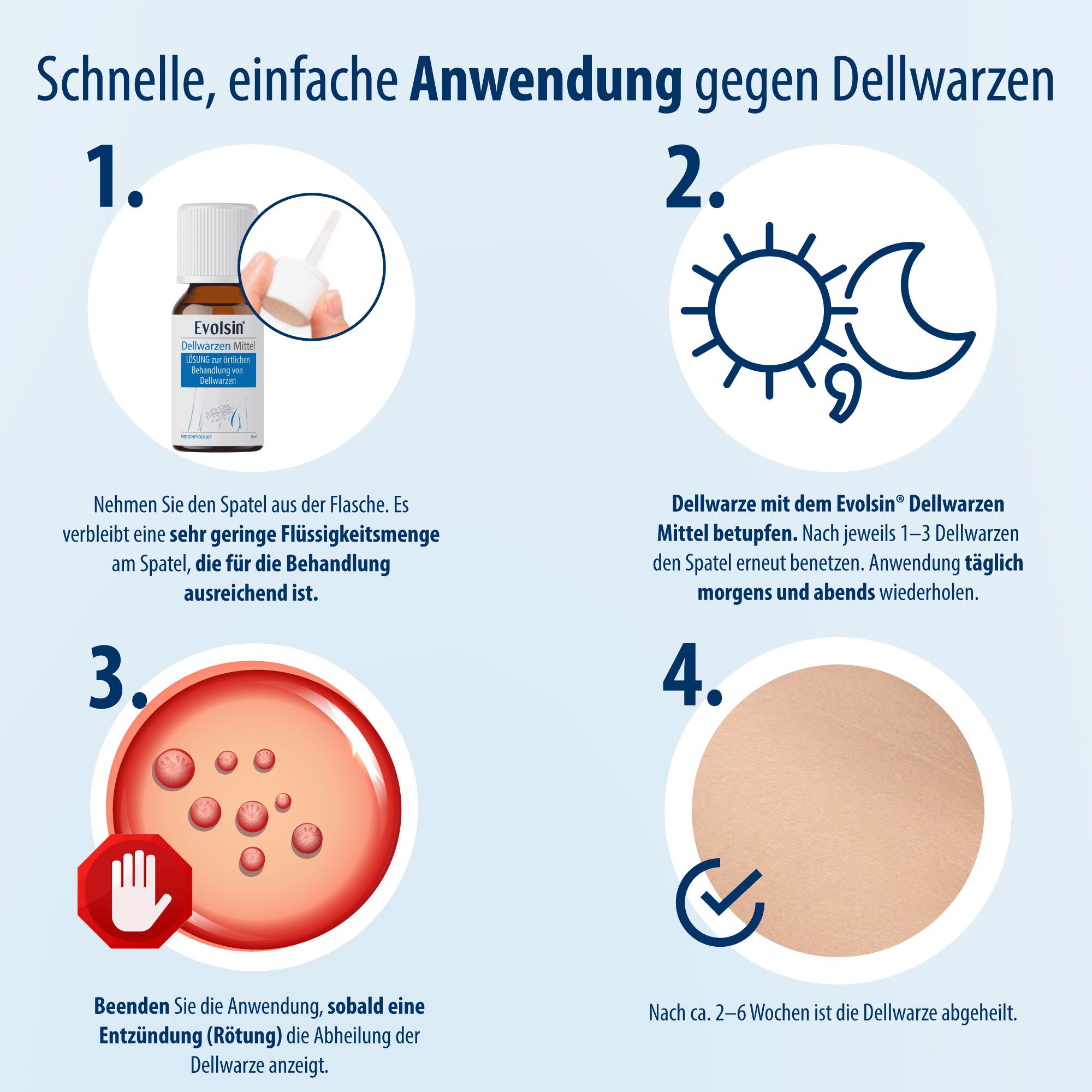 Anwendungsschritte für Evolsin. 1. Spatel. 2. Morgens und abends betupfen. 3. Rötung. 4. Abheilung.