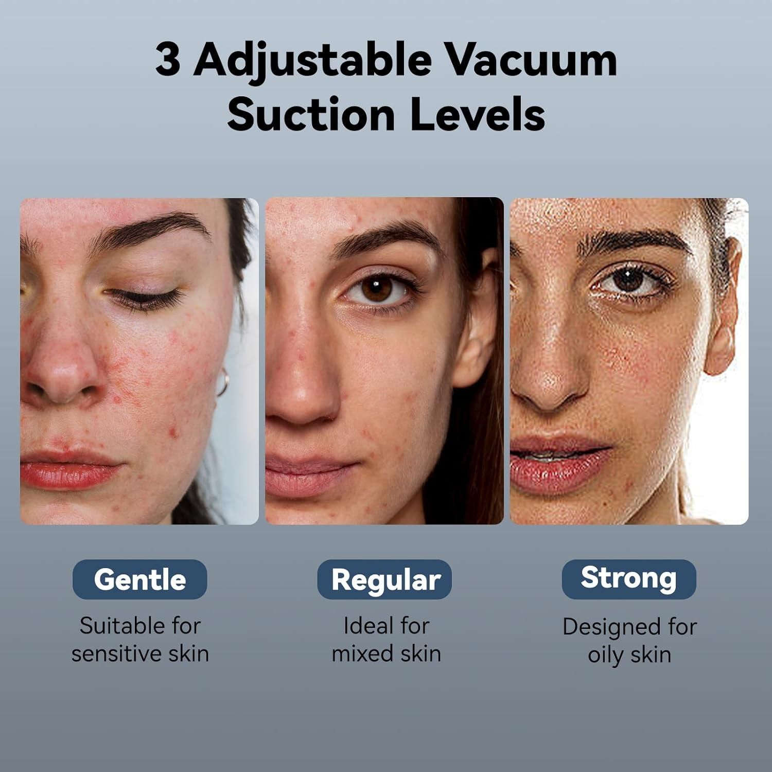 Drei Gesichter zeigen Hautzustände. Text: 3 Adjustable Vacuum Suction Levels. Sanft, Normal, Stark. Geeignet für verschiedene Hauttypen.