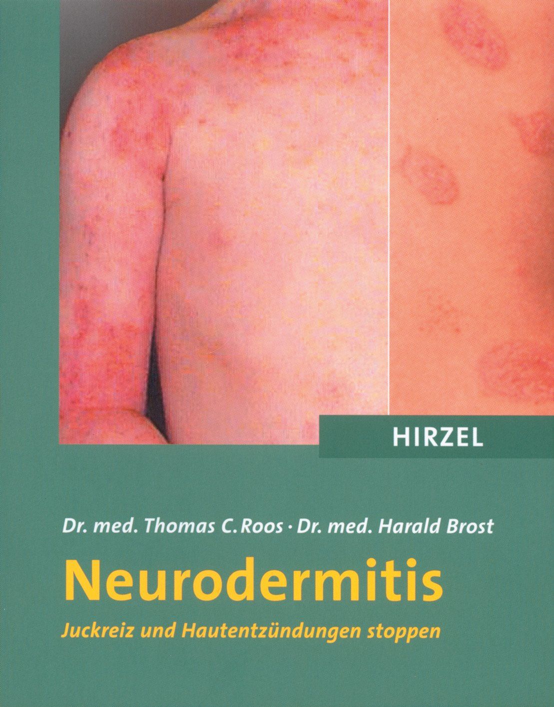 Buchcover mit dem Titel "Neurodermitis". Gezeigt werden Hautausschläge und ein Ausschnitt der Haut. Autoren: Dr. med. Thomas C. Roos und Dr. med. Harald Brost.
