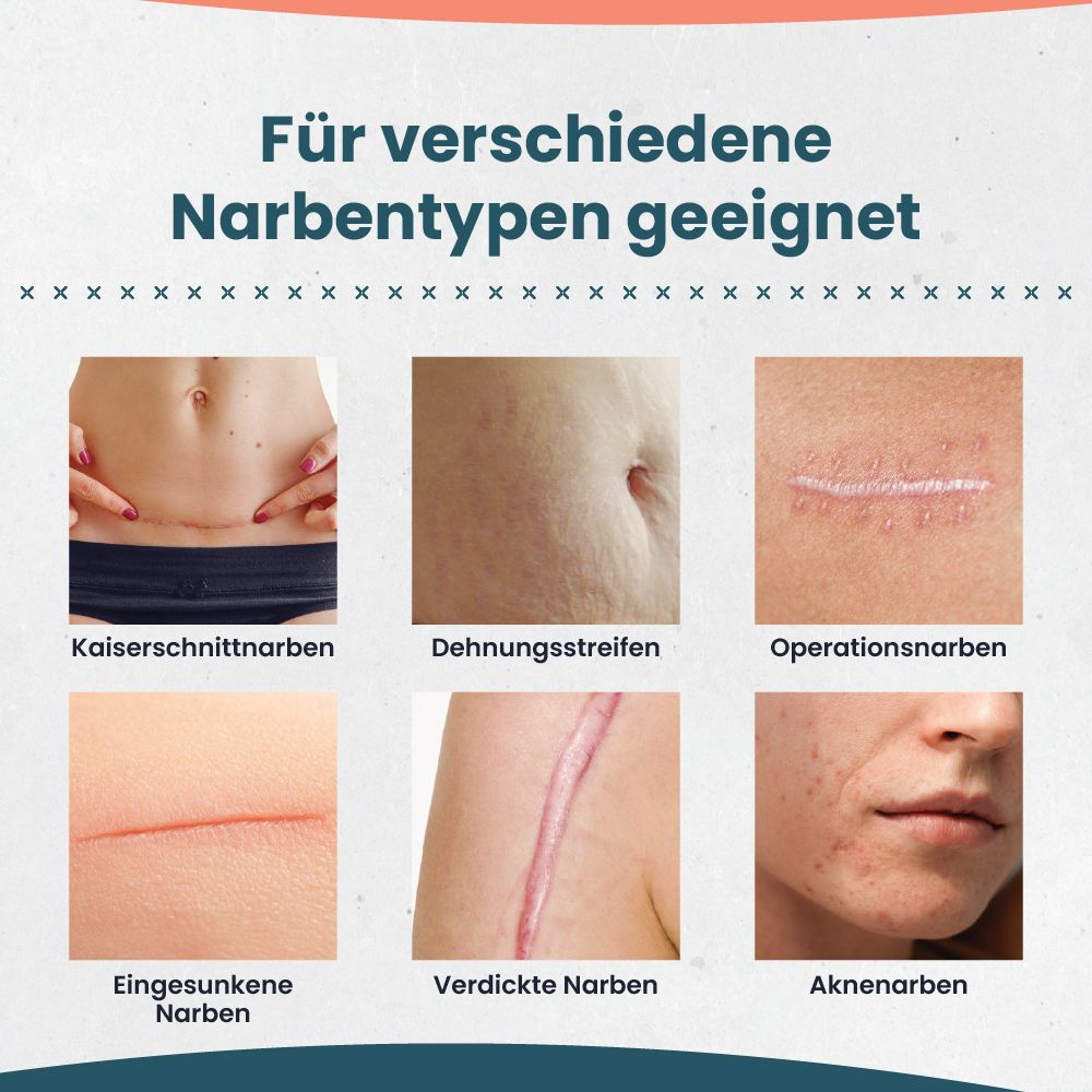 Geeignet für verschiedene Narbentypen: Kaiserschnitt-, Dehnungs-, Operations-, eingesunkene, verdickte und Akne-Narben.