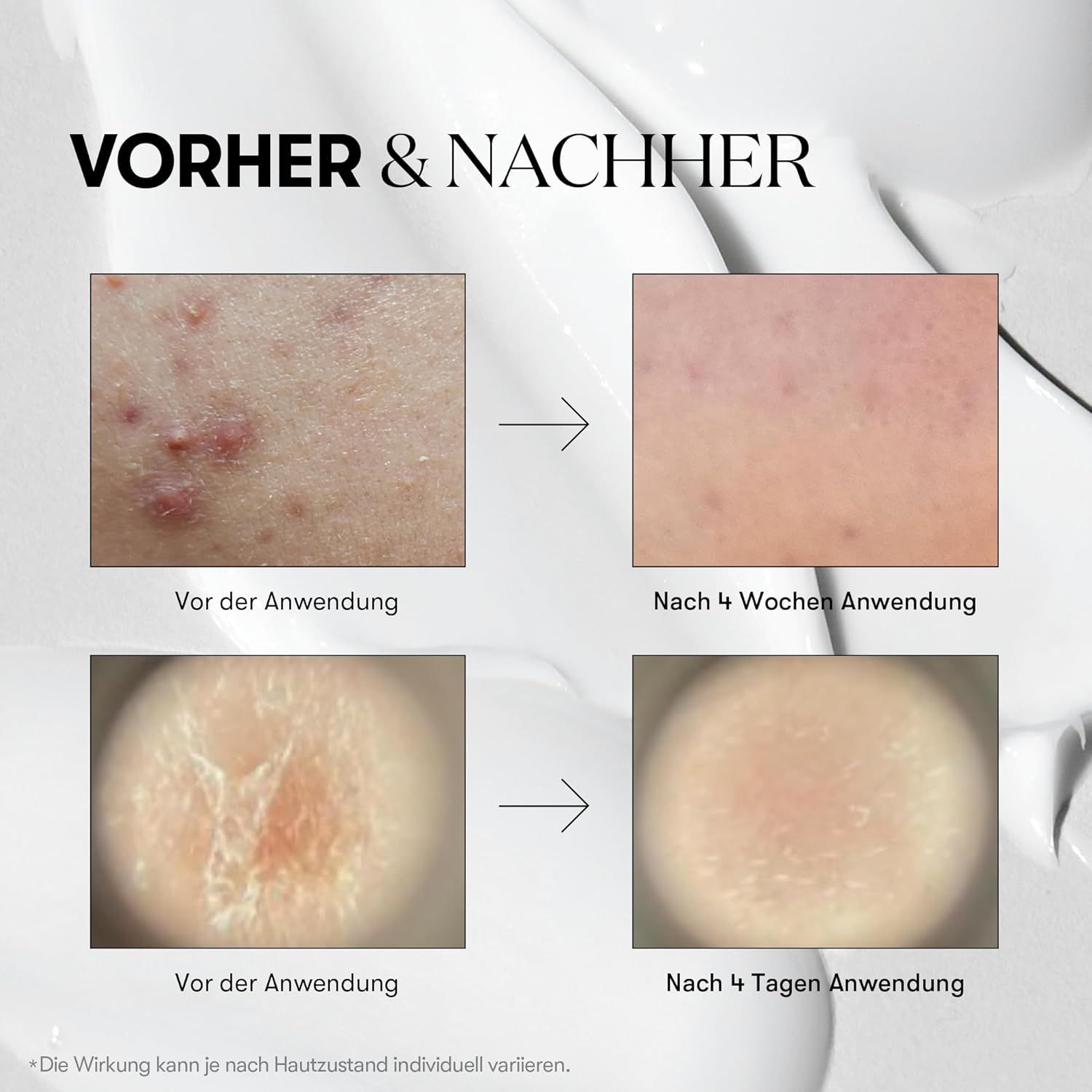 Vorher-Nachher-Vergleich. Bilder zeigen Haut vor und nach der Anwendung. Vergrößerte Ansichten zeigen Veränderungen.