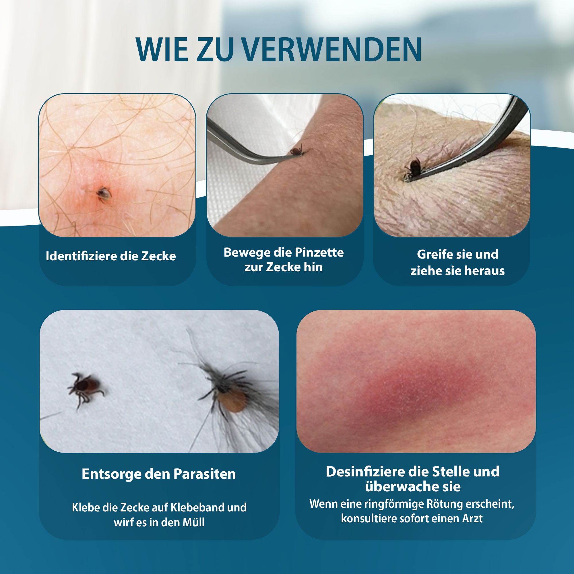 Anleitung zur Zeckenentfernung: Identifizieren, greifen, ziehen, entsorgen, desinfizieren.
