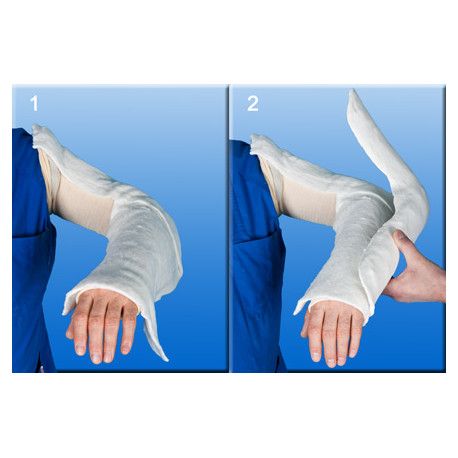 Zwei Bilder: Arm in Gipsverband. Auf blauem Hintergrund.