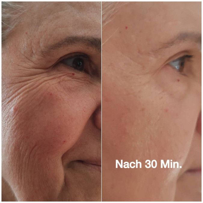Gesicht mit Augenpartie. Links: Haut mit Falten. Rechts: Haut glatter. Text: Nach 30 Min.