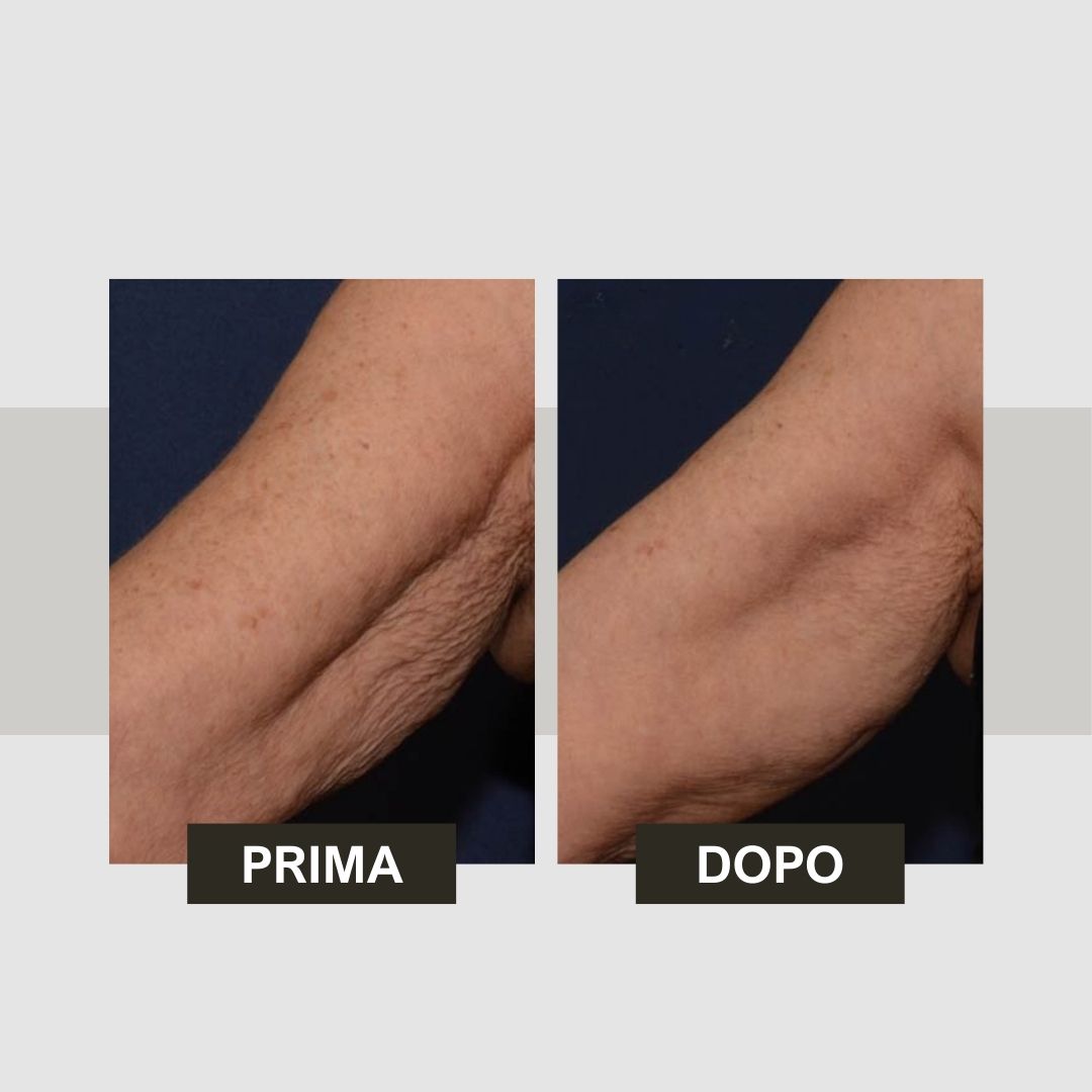 Confronto prima-dopo. Braccia con cambiamenti cutanei. Testo: Prima, Dopo.
