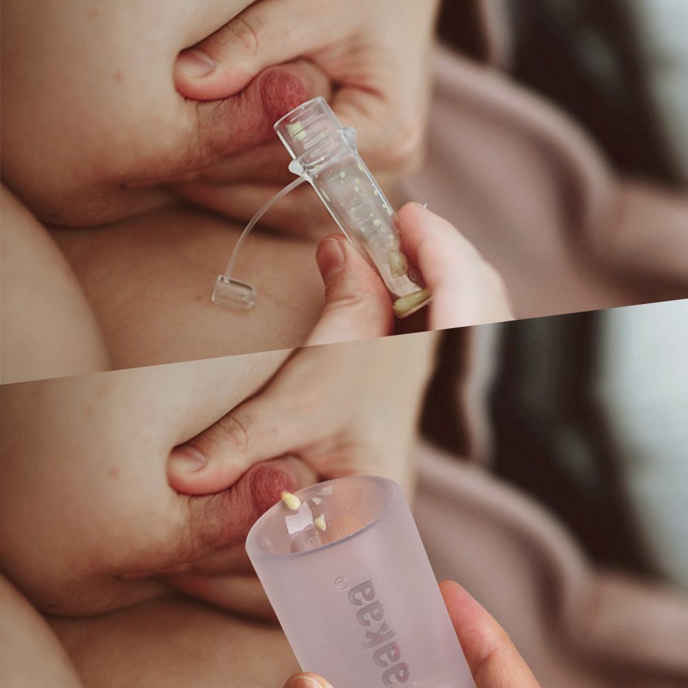 Kolostrum-Sammler während des Stillens. Der Sammler enthält gelbe Flüssigkeit.