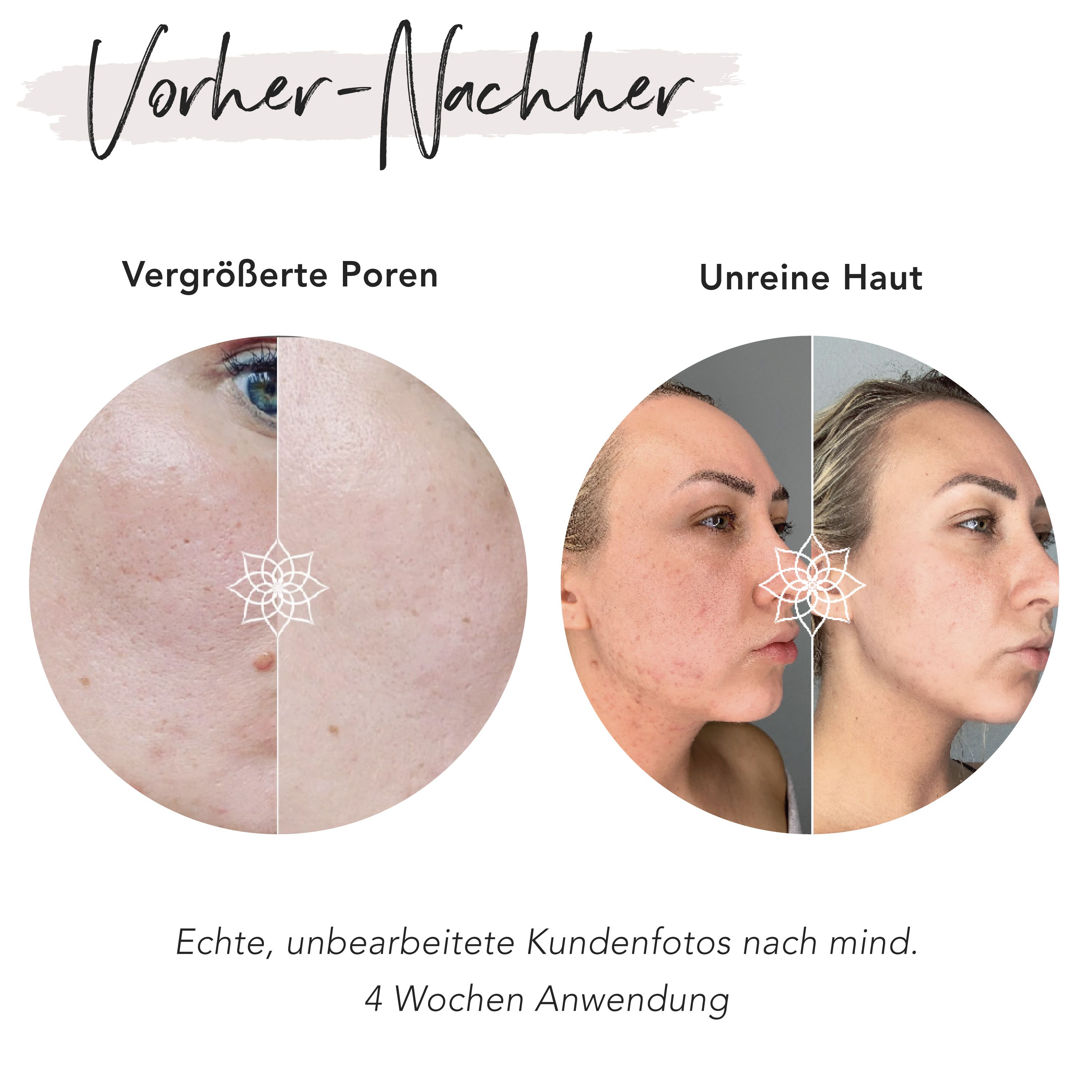 Vorher-Nachher-Vergleich. Vergrößerte Poren und unreine Haut. Echte Kundenergebnisse nach 4 Wochen Anwendung.