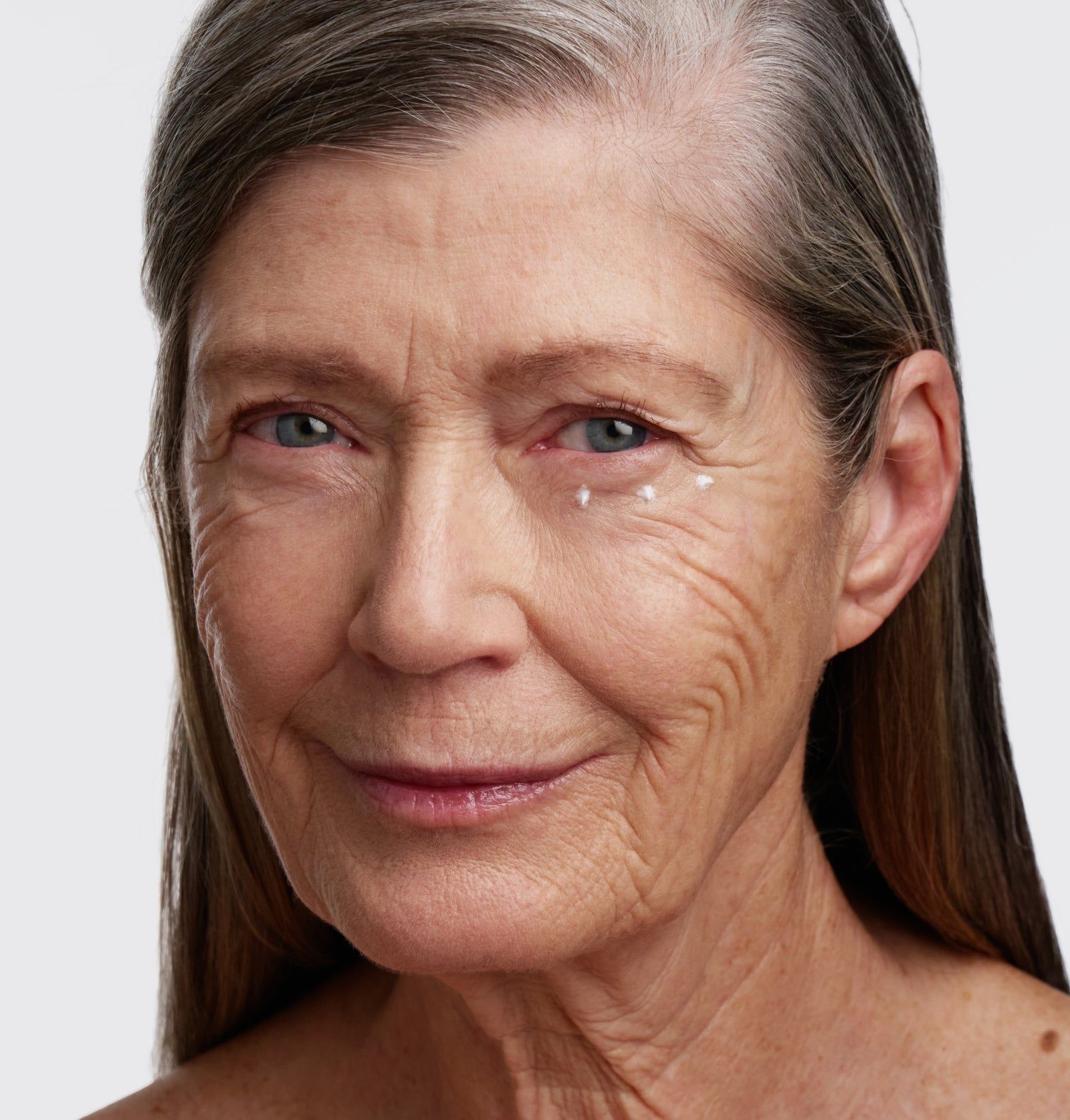 Ältere Frau mit grauen Haaren. Auf der Haut unter den Augen sind kleine, weiße Punkte zu sehen.