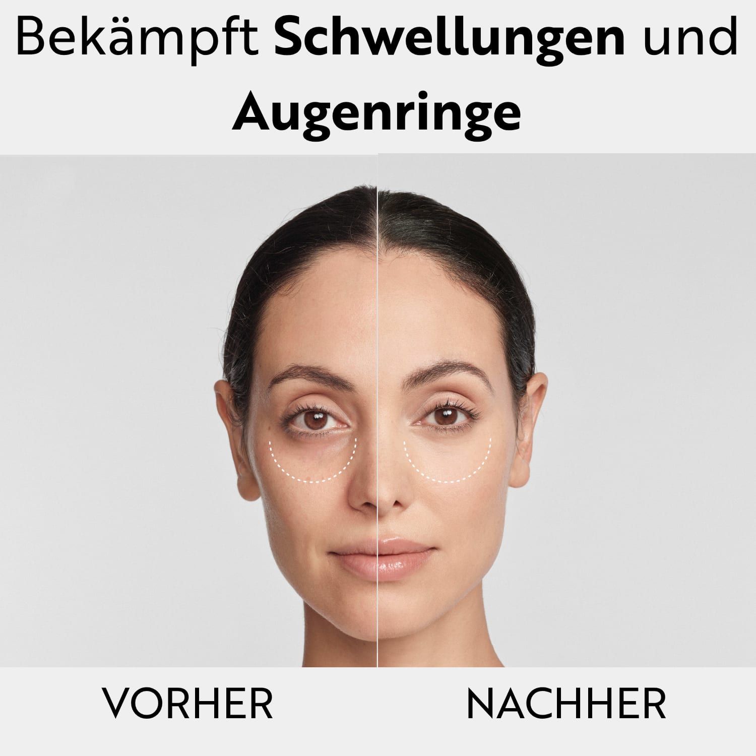 Vorher-Nachher-Vergleich einer Frau, die Schwellungen und Augenringe unter den Augen zeigt.