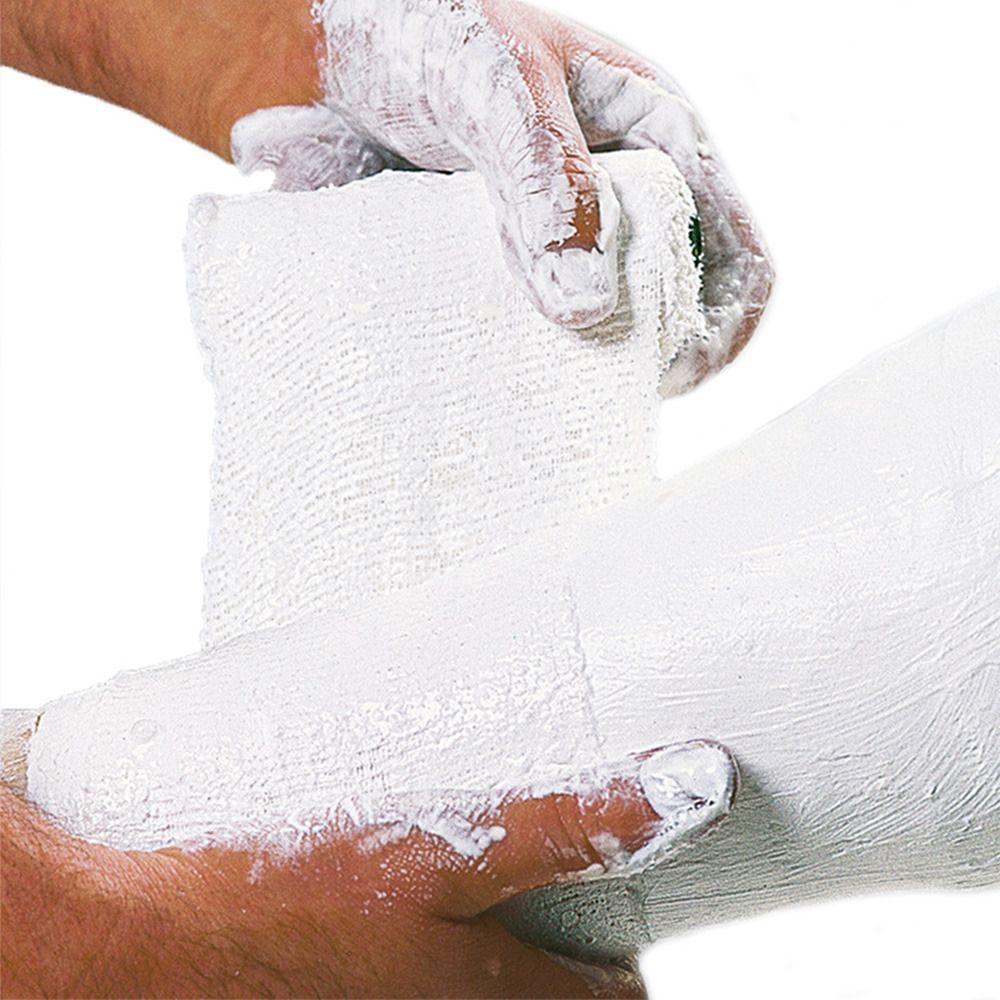 Gipsbinde wird um ein Bein gewickelt. Hände mit Gips. Weißes Verbandsmaterial.