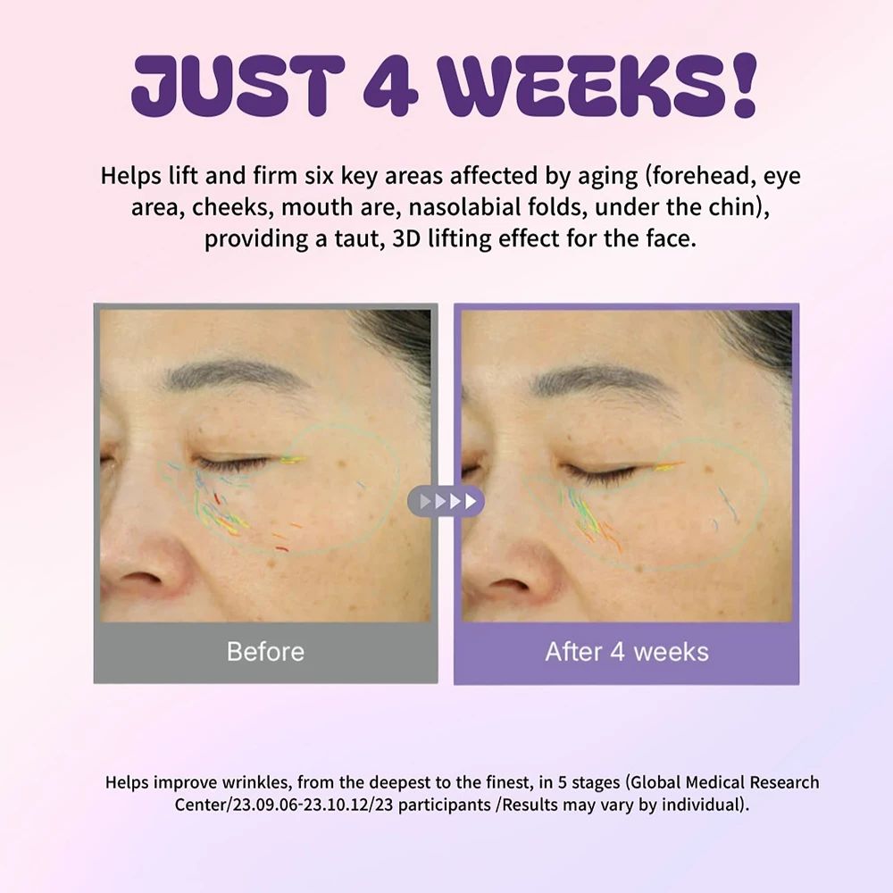 Vorher-Nachher-Vergleich von Augenpartien. Text: JUST 4 WEEKS! Beschreibung der Ergebnisse.