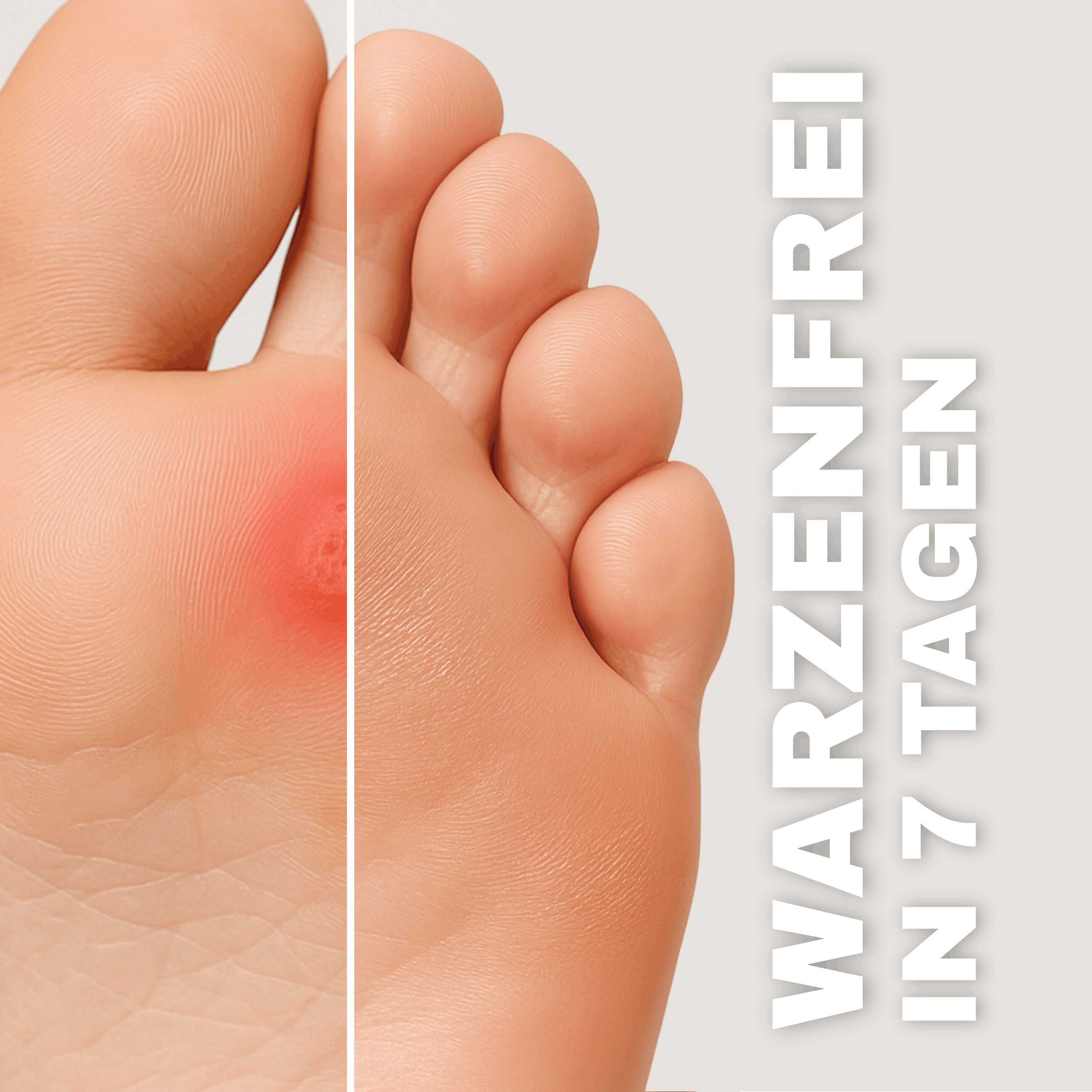 Health Press Warzenentferner – 2 ml – Warzen entfernen an Händen & Füßen – nur 1 Anwendung nötig