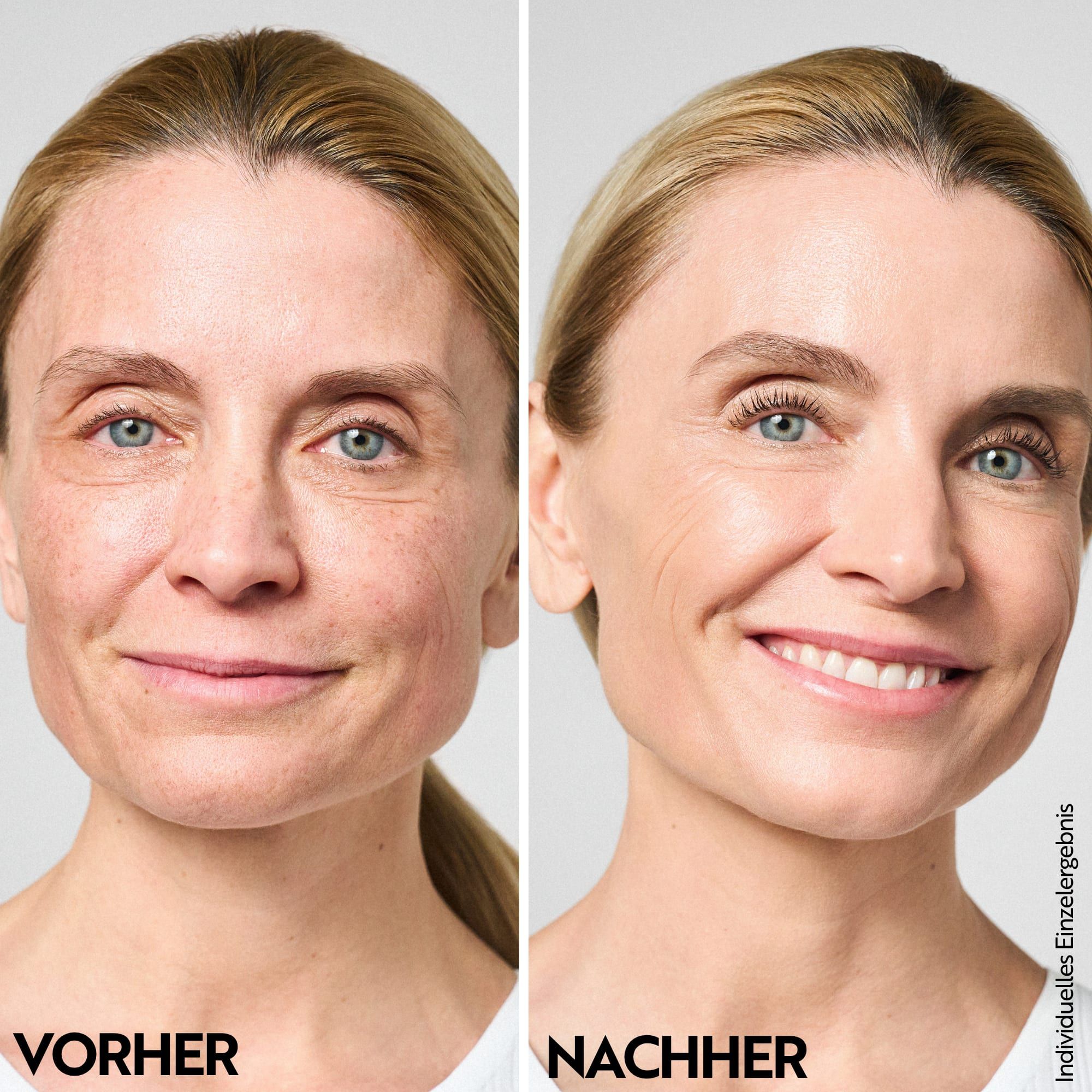 Vorher-Nachher-Vergleich einer Frau, die M. Asam AQUA INTENSE Getönte Hyaluron Tagescreme verwendet.