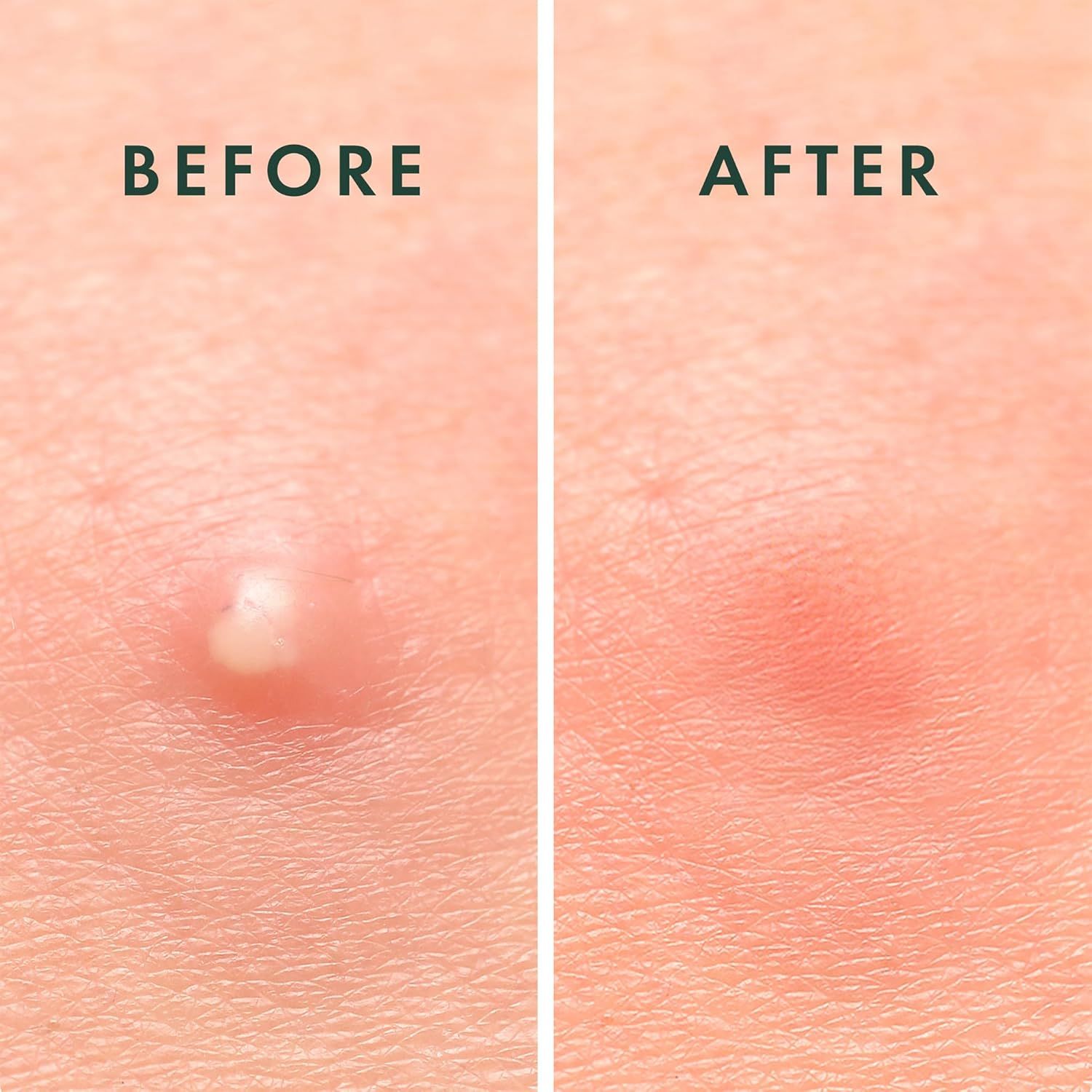 Zwei Nahaufnahmen. Links: Hautunreinheit. Rechts: Haut nach Behandlung. Text: Before, After.