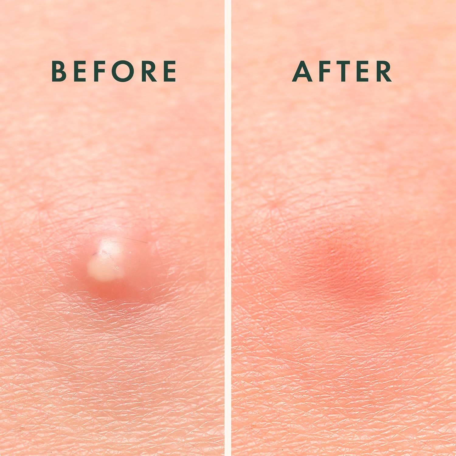 Vorher-Nachher-Vergleich. Links: Pickel. Rechts: Rötung. Keine Pflaster sichtbar.