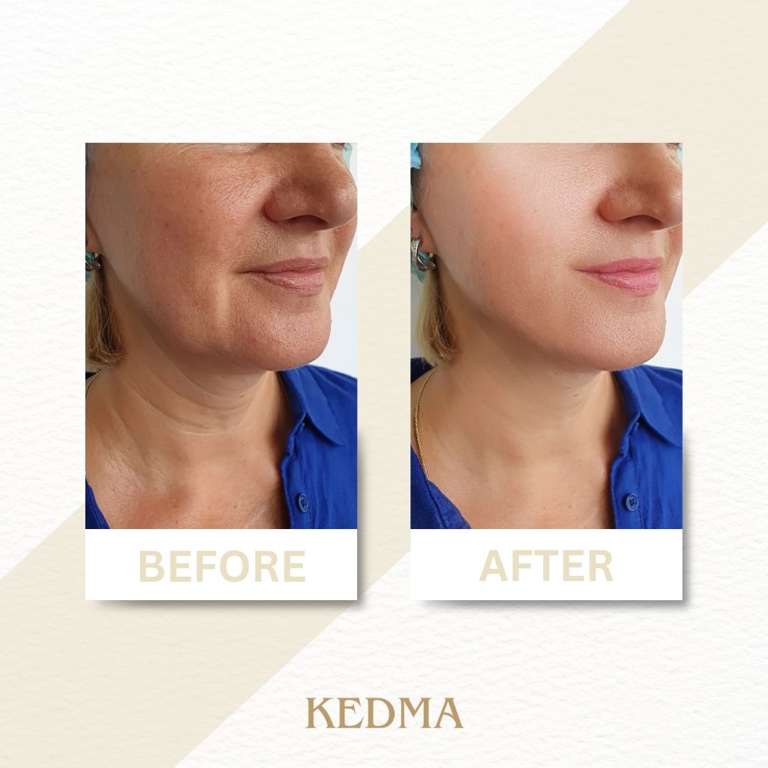 Comparaison avant-après du cou et du décolleté. Marque : Kedma.
