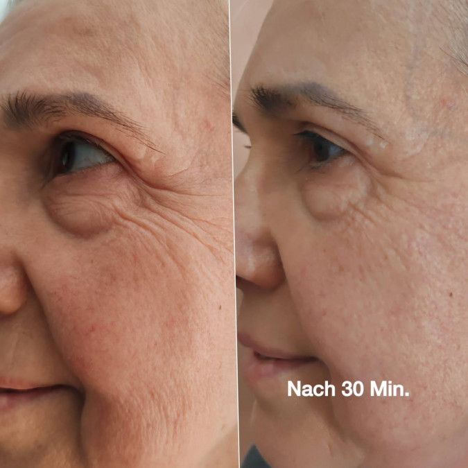 Gesicht mit Augenpartie. Links: Haut mit Falten. Rechts: Haut glatter. Text: Nach 30 Min.