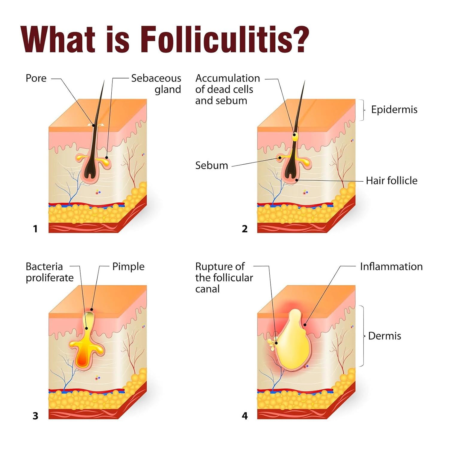 LMNOOP Follikulitis Creme  Kopfhaut & Körperhaut