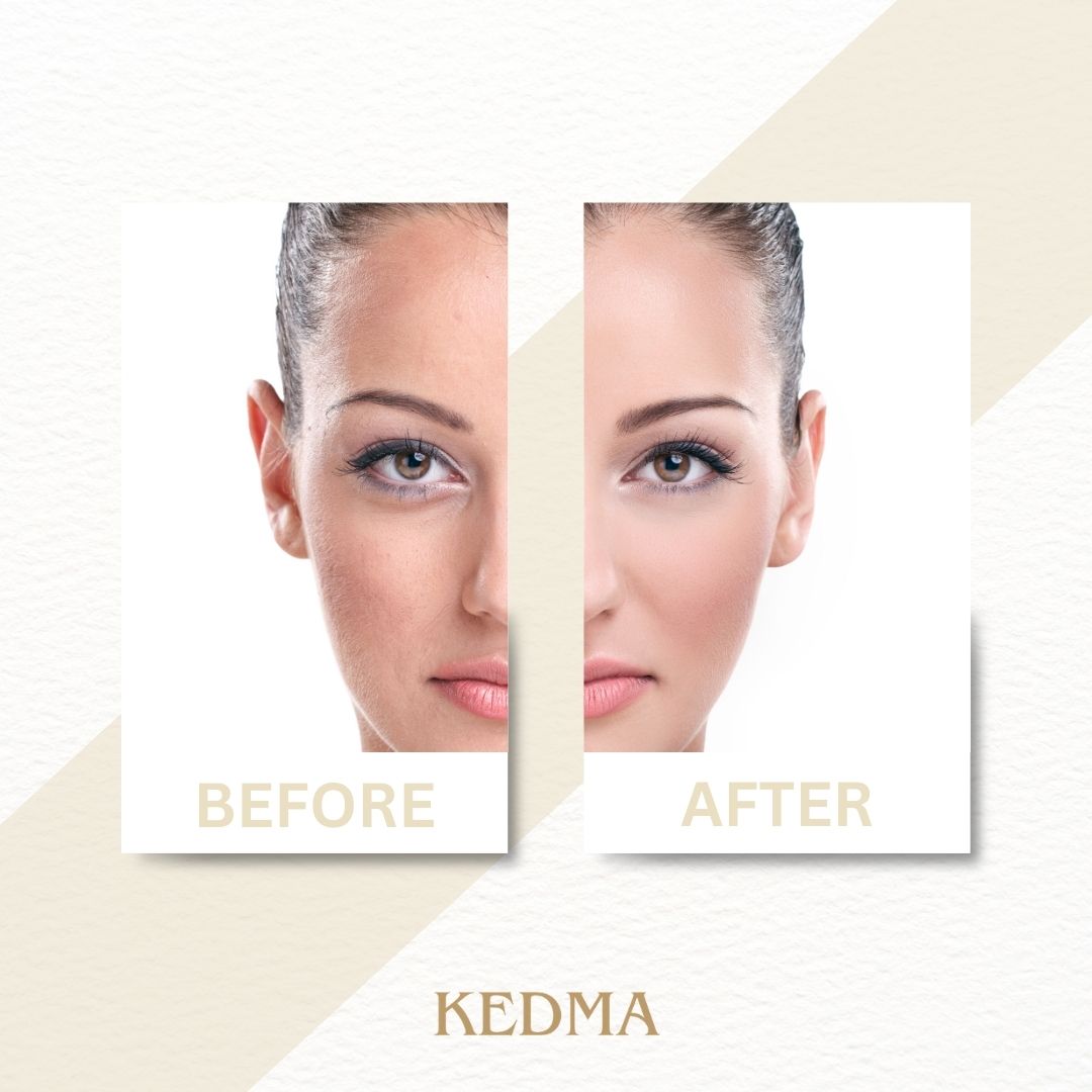 Kedma - H A Boost Hyaluronsäure-Ampullen