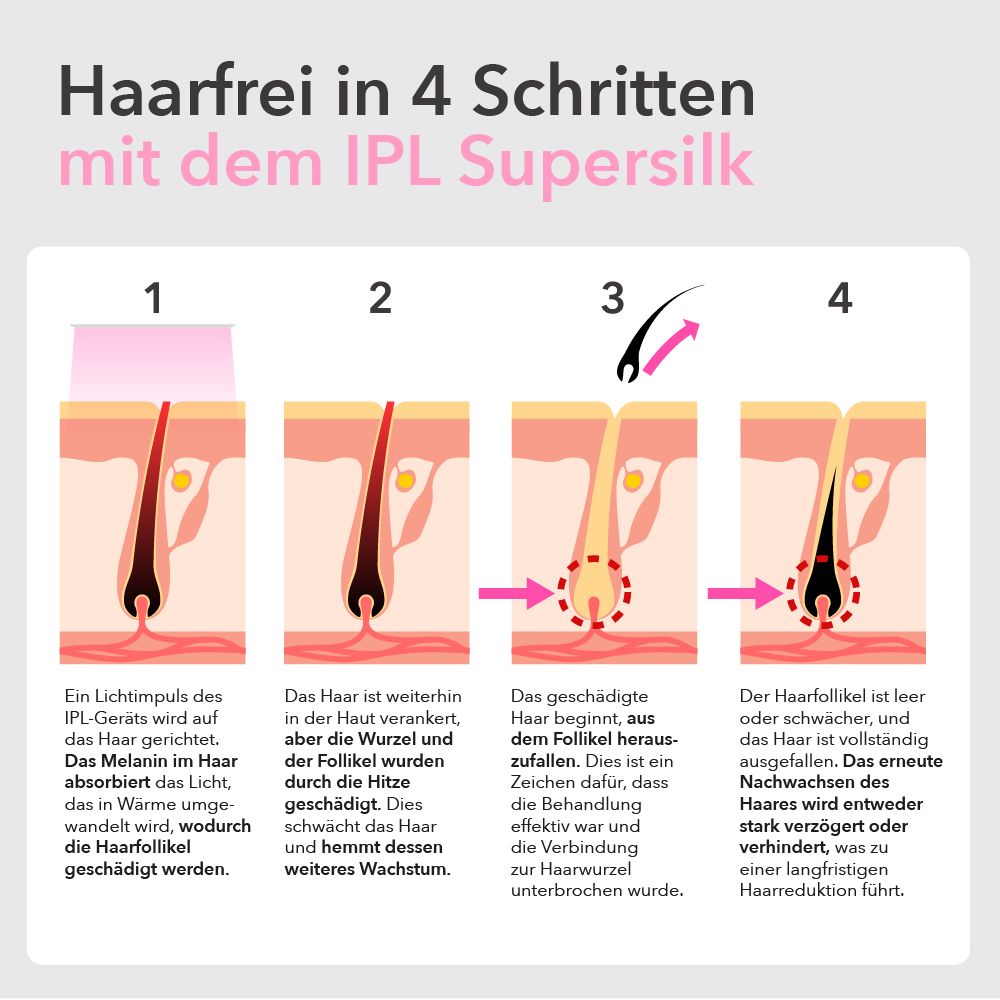 Vier Schritte der Haarentfernung mit IPL. Diagramm zeigt den Prozess im Haarfollikel.