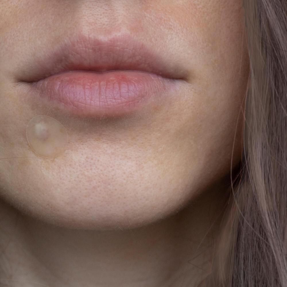 Australian Bodycare Pickel Patches mit Hyaluronsäure & Salicylsäure