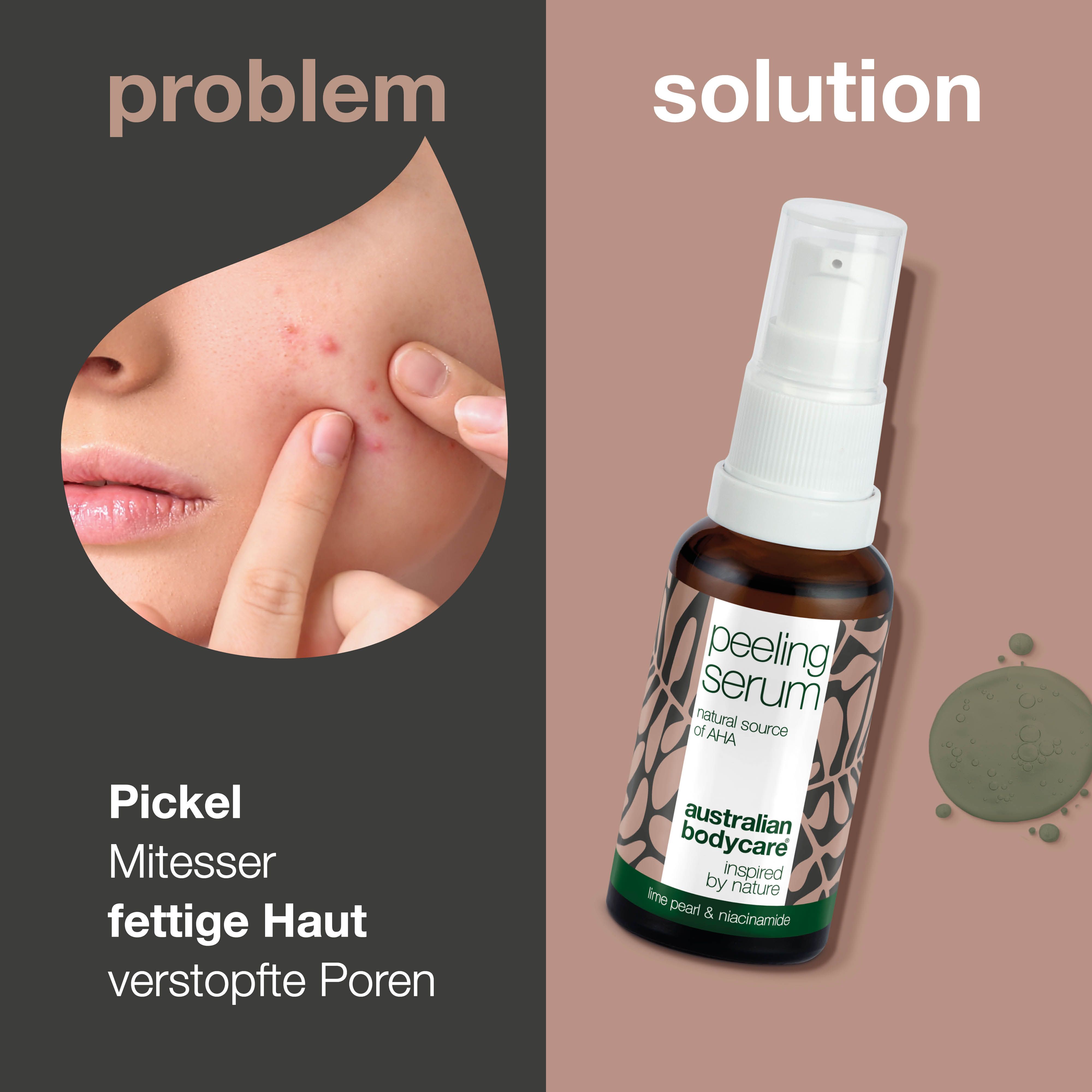 Gesicht mit Pickeln. Rechts: Flasche Peeling Serum. Text: Pickel, Mitesser, fettige Haut, verstopfte Poren.