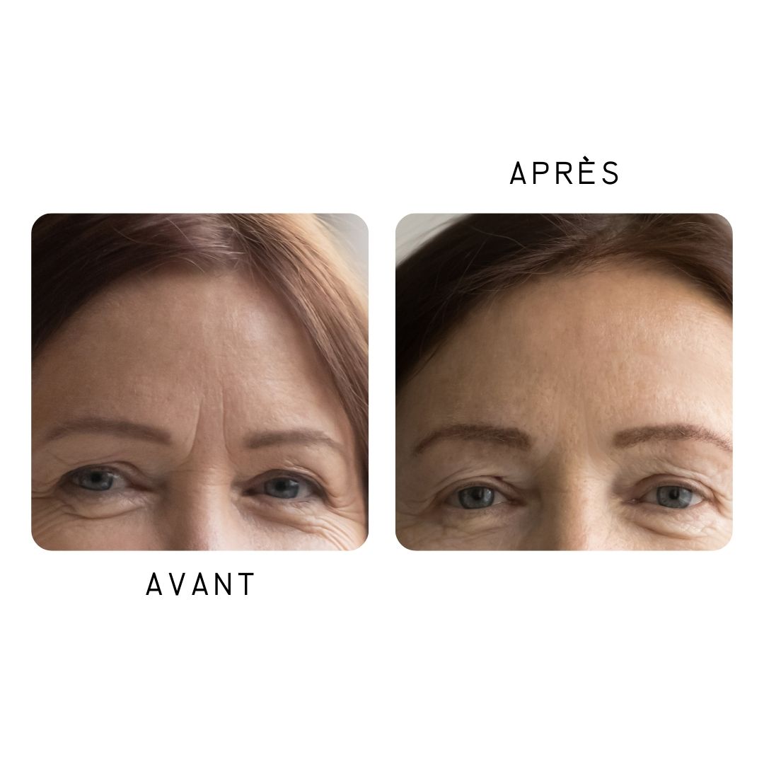 Comparaison avant-après. Gros plan sur les yeux et le front. Réduction des rides.