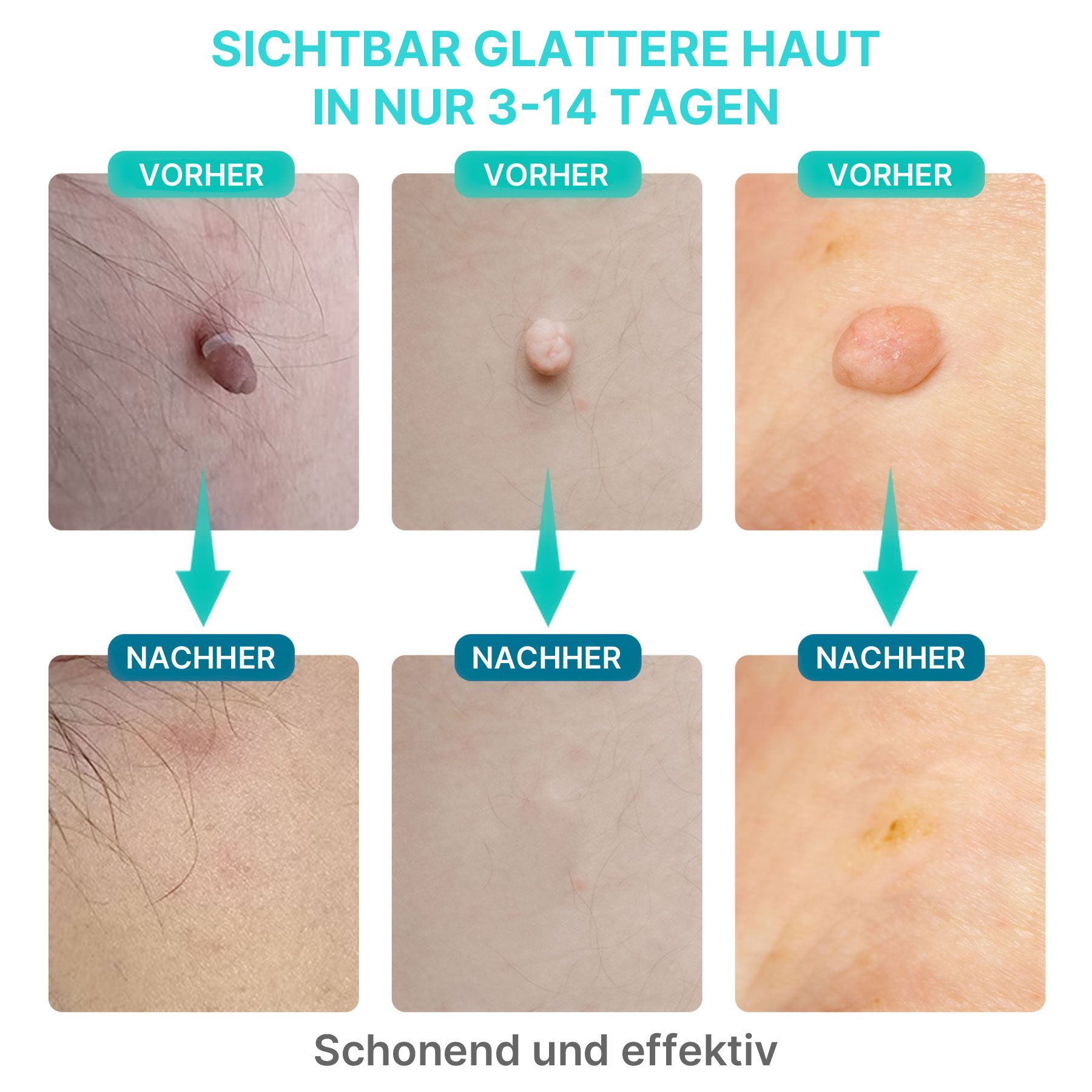 Vorher-Nachher-Vergleich von Hautanhängseln, die mit einem Hautanhängselentferner behandelt wurden.