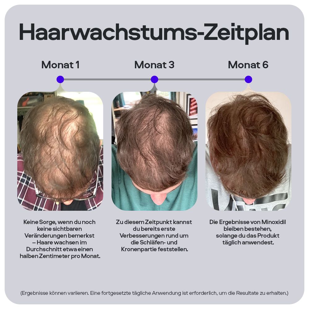 Drei Fotos von Kopfhautansichten. Text: Haarwachstums-Zeitplan. Monat 1, 3 und 6. Ergebnisse von Minoxidil.