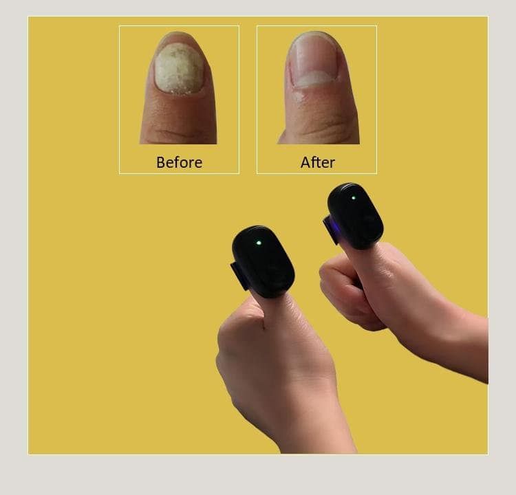 Vorher-Nachher-Vergleich eines Nagels; zwei Hände mit Lasertherapiegeräten auf den Daumen.