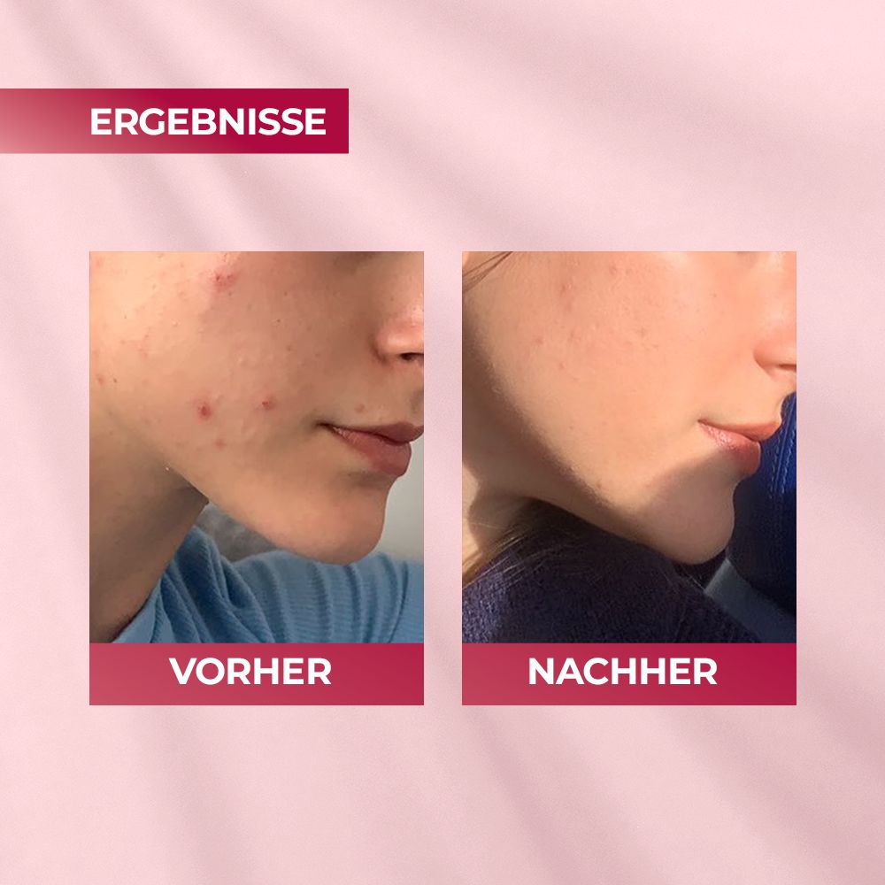 Vorher/Nachher-Vergleich. Gesichtshaut mit Pickeln, dann verbesserte Haut. Text: Ergebnisse.