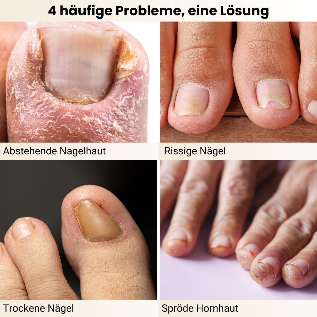 Vier häufige Nagelprobleme: abstehende Nagelhaut, rissige Nägel, trockene Nägel, spröde Hornhaut.