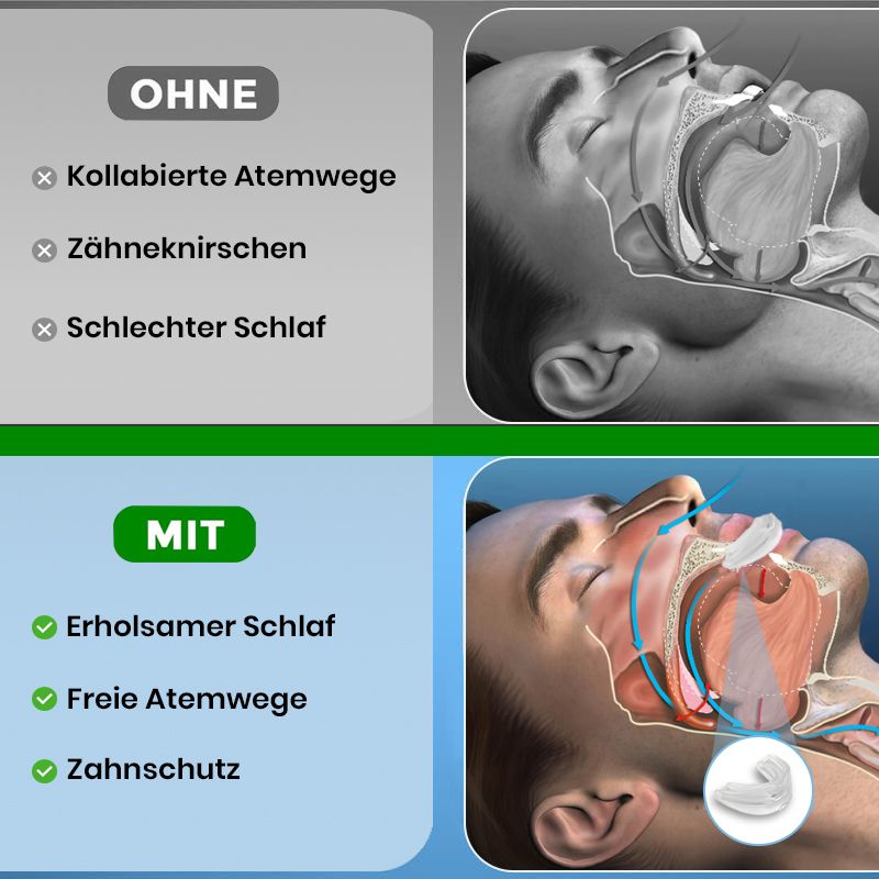 Vergleich: Ohne (kollabierte Atemwege, Zähneknirschen, schlechter Schlaf) vs. Mit (erholsamer Schlaf, freie Atemwege, Zahnschutz). Illustrationen.