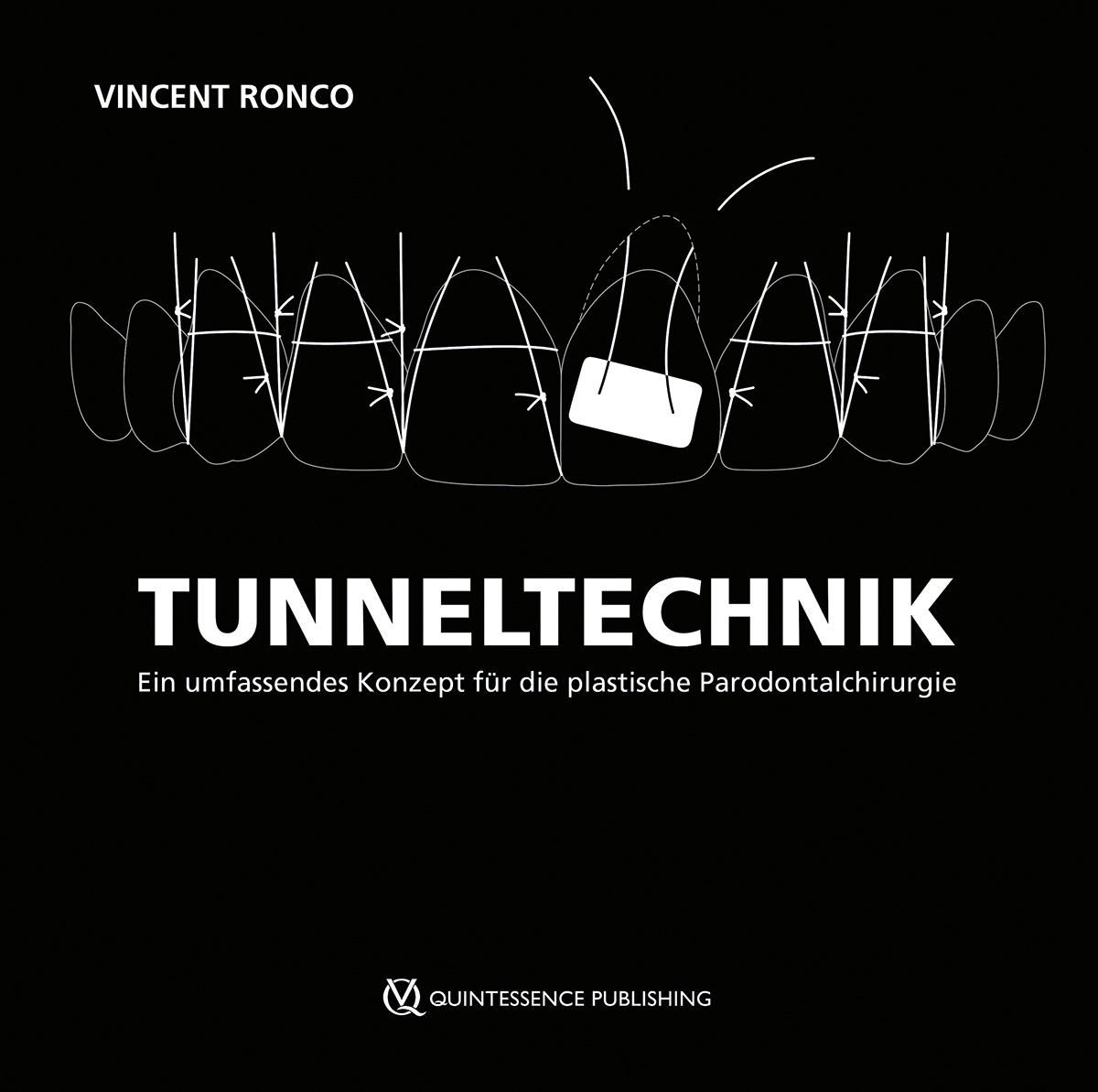 Tunneltechnik Ein umfassendes Konzept für die plastische Parodontalchirurgie
