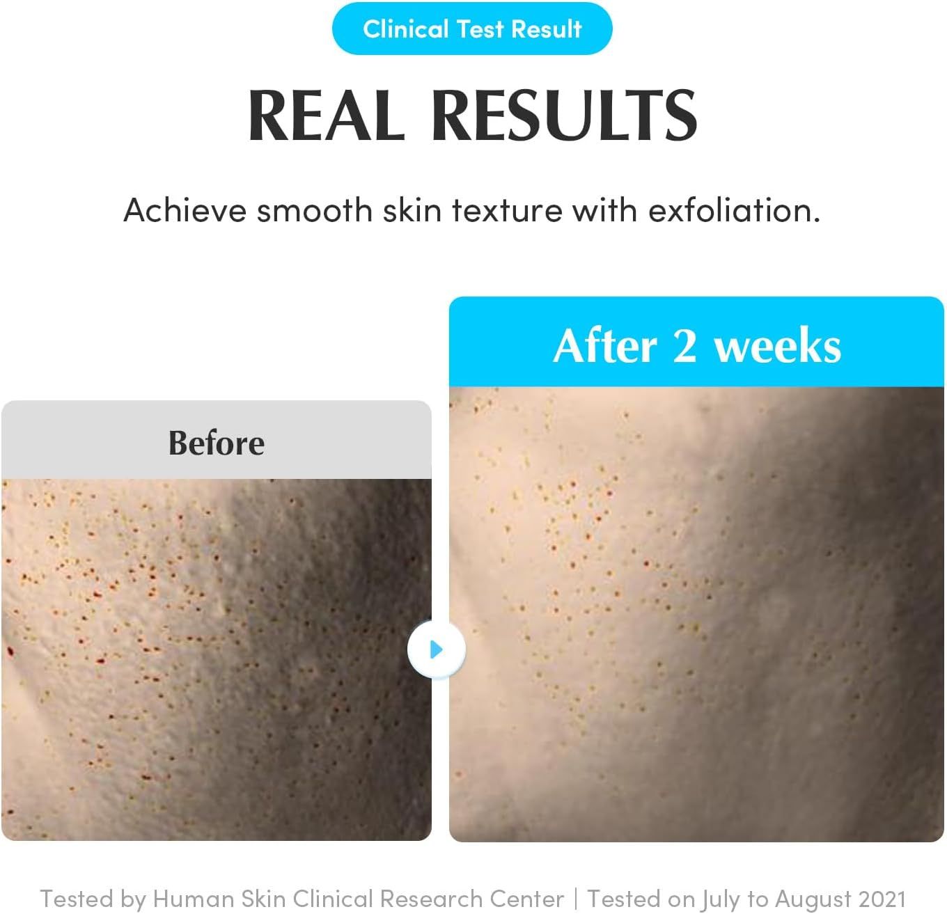 Vorher-Nachher-Vergleich der Haut. Nach 2 Wochen. Reduzierte Poren, glattere Textur.