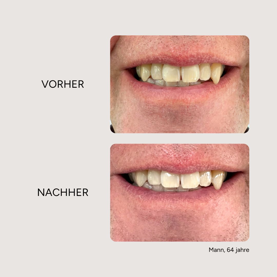 Vorher-Nachher-Vergleich. Zähne vor und nach der Behandlung. Text: Vorher, Nachher. Mann, 64 Jahre.