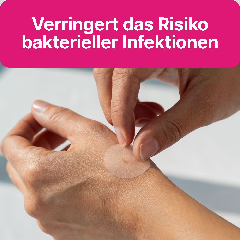 Person legt einen transparenten Warzenpatch auf eine Hand. Der Patch ist rund und hat eine kleine Erhebung in der Mitte.