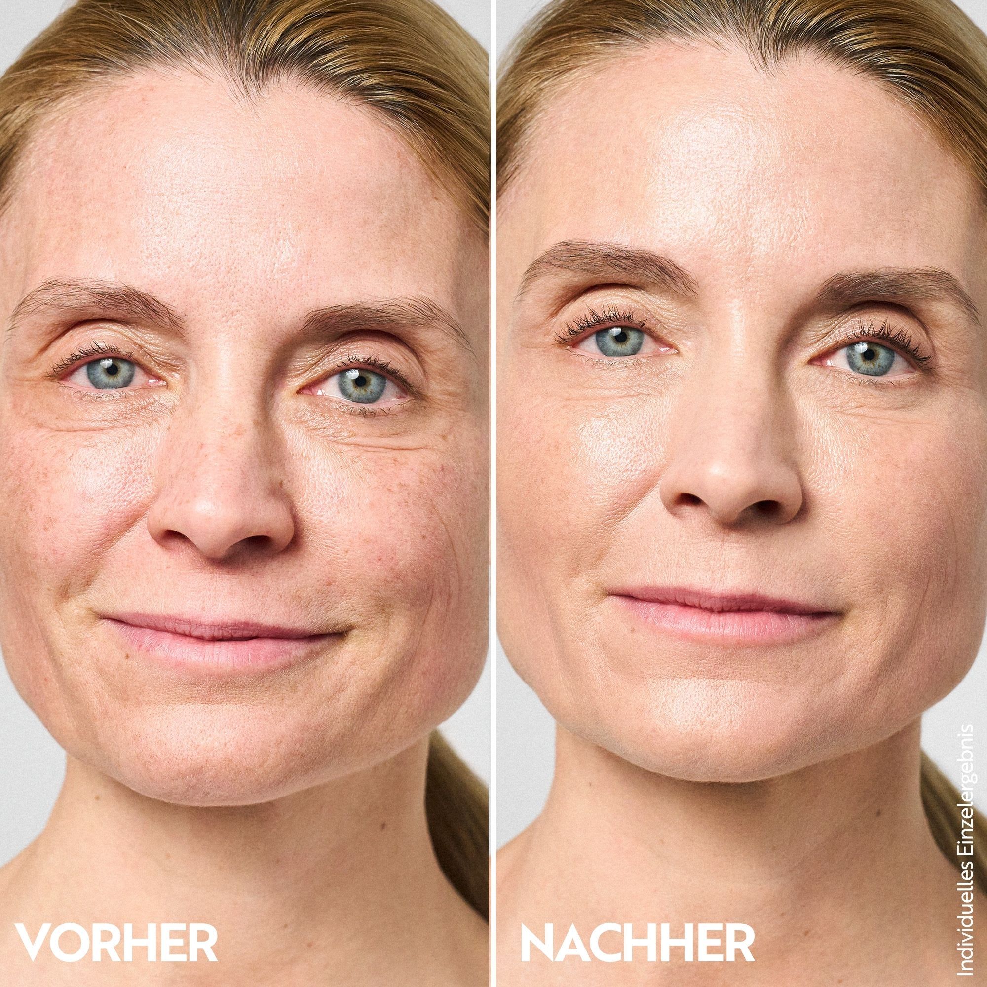 Vorher-Nachher-Vergleich einer Frau, die M. Asam Aqua Intense Hyaluron Nachtcreme verwendet.