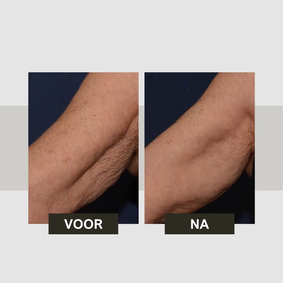 Voor-na vergelijking. Armen met huidveranderingen. Tekst: Voor, Na.