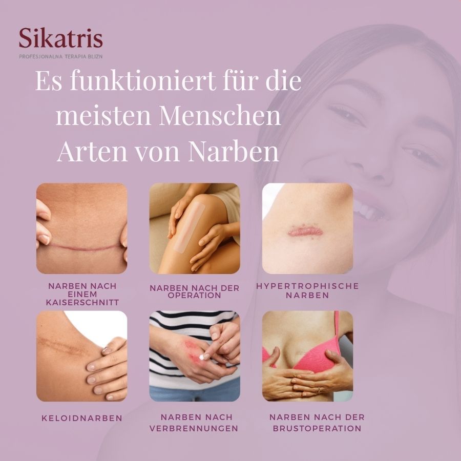 Grafik mit verschiedenen Narbenarten. Text: Es funktioniert für die meisten Menschen Arten von Narben.