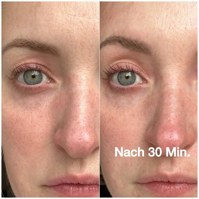 Gesicht mit Augenpartie. Links: Haut mit Falten. Rechts: Haut glatter. Text: Nach 30 Min.