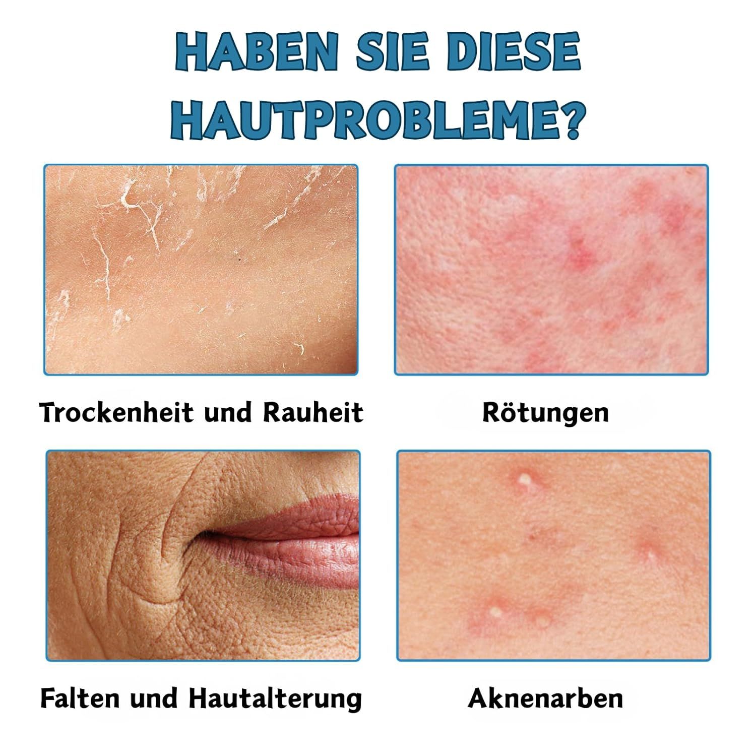 SUMMISHI Micro Infusion System: Microneedling Roller
