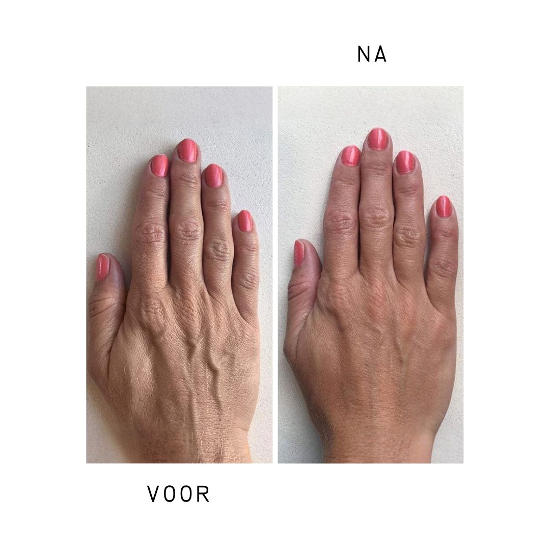 Twee handen, één voor, één na gebruik. Rode nagels. Verbeterde huidtextuur.