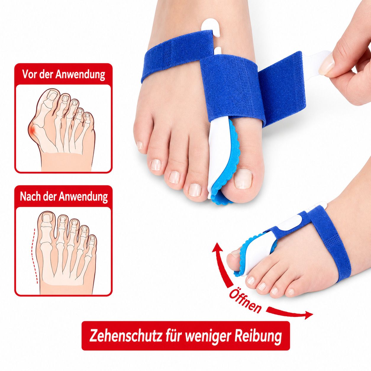 Anwendung einer Hallux-Nachtbandage: Vorher-Nachher-Vergleich der Zehenstellung. Zehenschutz für weniger Reibung.