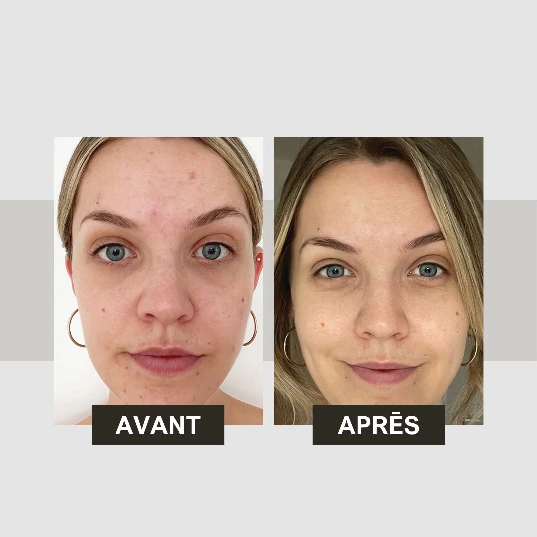 Comparaison avant-après. Deux photos de femmes. Gauche : imperfections cutanées. Droite : peau lisse. Tonique visage.